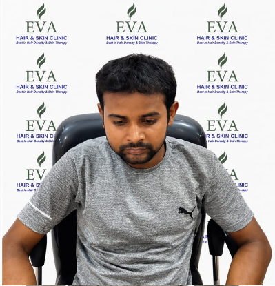 After hair transplant result 7